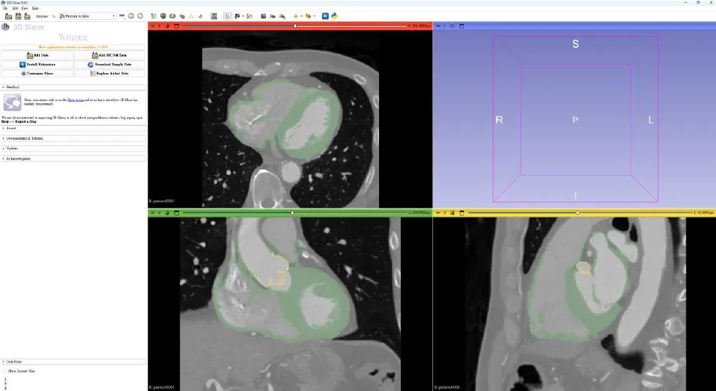 3D CT 心臟肌肉影像分割